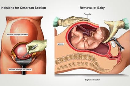 Caesarean Section