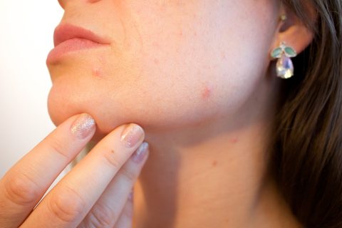 Acne, A Devastating Complication of PCOS