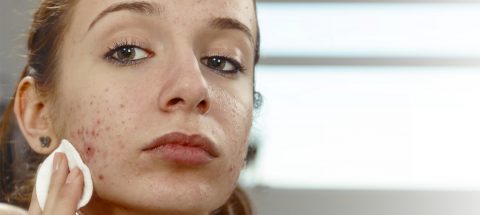 Managing PCOS related ACNE
