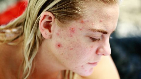 How to deal with acne problem in PCOS