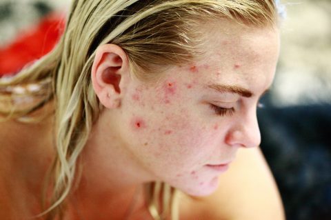 How to deal with acne problem in PCOS