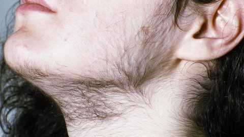 Hirsutism in Polycystic ovary syndrome