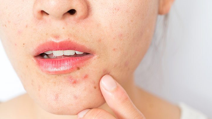 polycystic ovarian syndrome acne help